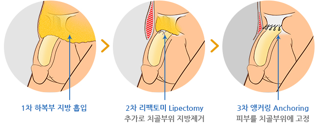 1차 하복부 지방 흡입 / 2차 리팩토미 Lipectomy 추가로 치골부위 지방제거 / 3차 앵커링 Anchoring 피부를 치골부위에 고정