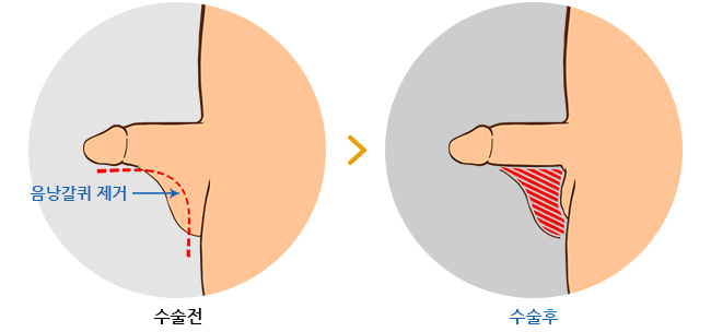 하이맨 음낭갈퀴제거 길이연장술 전 /후