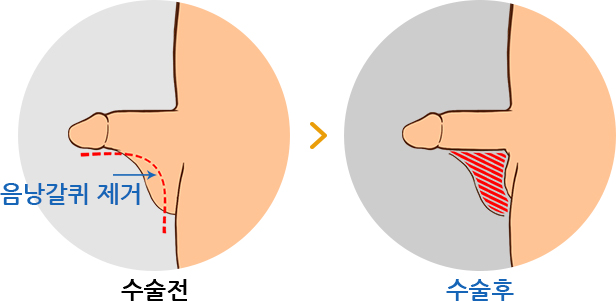 하이맨 음낭갈퀴제거 길이연장술 전 /후