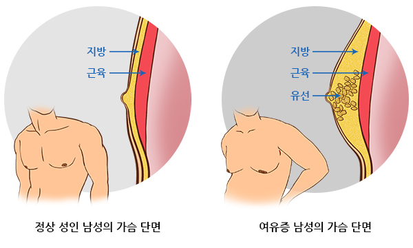 여(성형)유(방)증