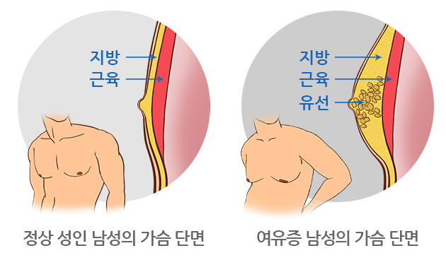 여(성형)유(방)증